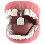 INNESTO DELL’IMPIANTO DENTALE